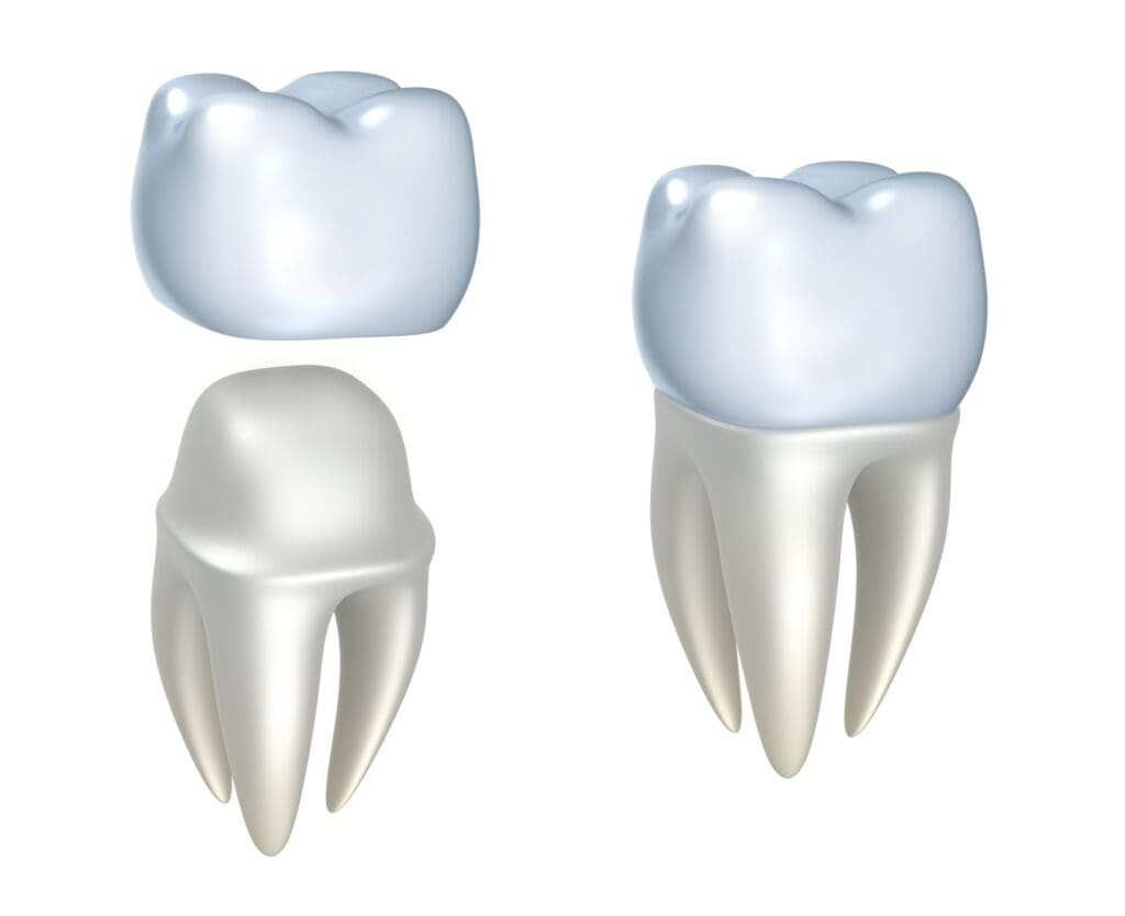 dental crowns at howze dental group desoto tx