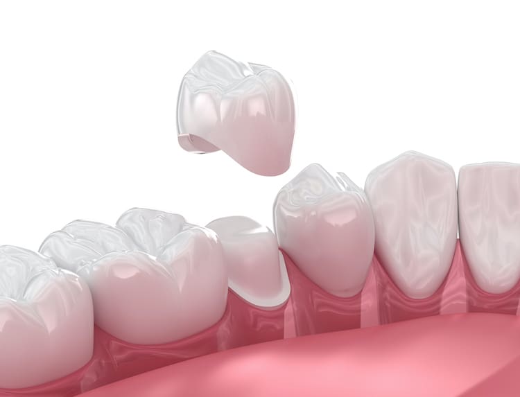 Understanding when and why you might need a dental crown can help you make informed decisions about your dental health.